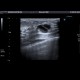 Galactocoele: US - Ultrasound