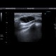 Galactocoele: US - Ultrasound