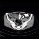 Gangrenous appendicitis: CT - Computed tomography