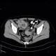Gangrenous appendicitis: CT - Computed tomography