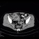 Gangrenous appendicitis: CT - Computed tomography