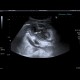 Gangrenous appendicitis: US - Ultrasound