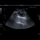 Gangrenous appendicitis: US - Ultrasound