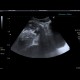 Gangrenous appendicitis: US - Ultrasound