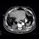 Gangrene of the liver: CT - Computed tomography