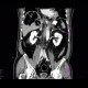 Gangrene of the liver: CT - Computed tomography