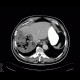Gangrene of the liver: CT - Computed tomography