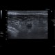 Appendicitis, gangrenous appendicitis: US - Ultrasound