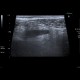 Appendicitis, gangrenous appendicitis: US - Ultrasound