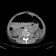 Gastrectasia, distension of stomach, ileus: CT - Computed tomography