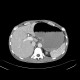 Gastrectasia, distension of stomach, ileus: CT - Computed tomography