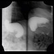 Gastroplication, bariatric surgery of stomach: RF - Fluoroscopy