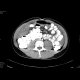 Gelatinous tumor spread in the abdominal cavity: CT - Computed tomography
