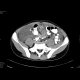 Gelatinous tumor spread in the abdominal cavity: CT - Computed tomography