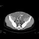Gelatinous tumor spread in the abdominal cavity: CT - Computed tomography
