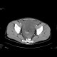 Gelatinous tumor spread in the abdominal cavity: CT - Computed tomography