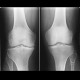 Gonarthrosis: X-ray - Plain radiograph
