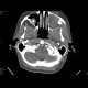 Gorlin Goltz Syndrom: CT - Computed tomography