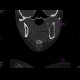 Gorlin Goltz Syndrom: CT - Computed tomography