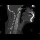 Gorlin Goltz Syndrom: CT - Computed tomography