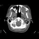 Gorlin Goltz Syndrom: CT - Computed tomography