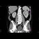 Renal cell carcinoma: CT - Computed tomography