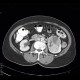 Renal carcinoma, Grawitz tumour: CT - Computed tomography