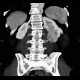 Renal carcinoma, Grawitz tumour: CT - Computed tomography