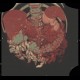 Renal carcinoma, Grawitz tumour: CT - Computed tomography