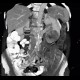 Renal carcinoma, Grawitz tumour: CT - Computed tomography