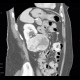 Renal carcinoma, Grawitz tumour: CT - Computed tomography