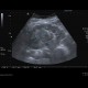 Renal carcinoma, Grawitz tumour: US - Ultrasound