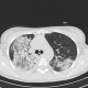 H1N1, atypical pneumonia: CT - Computed tomography