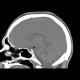 Hamartoma of tuber cinereum: CT - Computed tomography