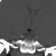 Hamartoma of tuber cinereum: CT - Computed tomography