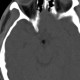 Hamartoma of tuber cinereum: CT - Computed tomography