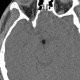 Hamartoma of tuber cinereum: CT - Computed tomography