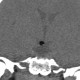 Hamartoma of tuber cinereum: CT - Computed tomography