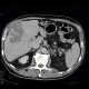Hepatocellular carcinoma, subcapsular bleeding: CT - Computed tomography