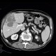 Hepatocellular carcinoma, subcapsular bleeding: CT - Computed tomography