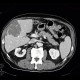 Hepatocellular carcinoma, subcapsular bleeding: CT - Computed tomography
