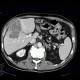 Hepatocellular carcinoma, subcapsular bleeding: CT - Computed tomography