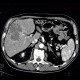 Hepatocellular carcinoma, subcapsular bleeding: CT - Computed tomography
