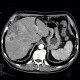 Hepatocellular carcinoma, subcapsular bleeding: CT - Computed tomography