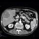 Hepatocellular carcinoma, subcapsular bleeding: CT - Computed tomography