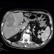 Hepatocellular carcinoma, subcapsular bleeding: CT - Computed tomography