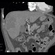 Hepatocellular carcinoma, subcapsular bleeding: CT - Computed tomography