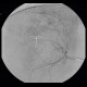 Hepatocellular carcinoma, subcapsular bleeding: AG - Angiography