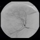 Hepatocellular carcinoma, subcapsular bleeding: AG - Angiography