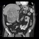 Hepatocellular carcinoma, HCC: CT - Computed tomography